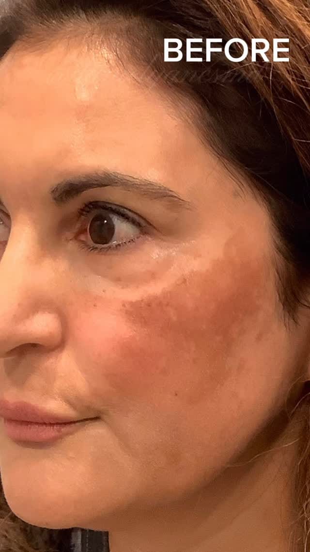 Post 4 by Daniel Yanes, MD, FAAD on Instagram (video)