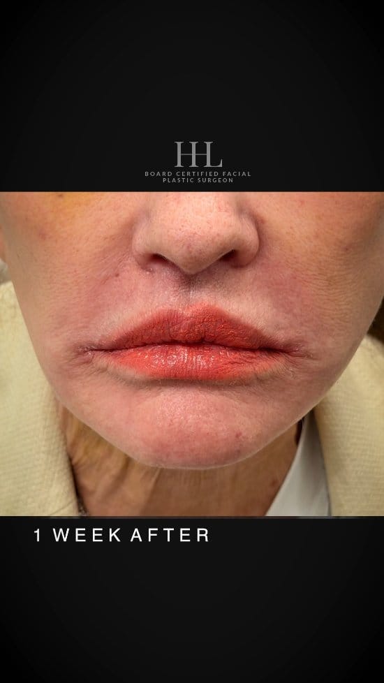 Post 6 by Harrison H Lee, MD, DMD, FACS on Instagram (video)