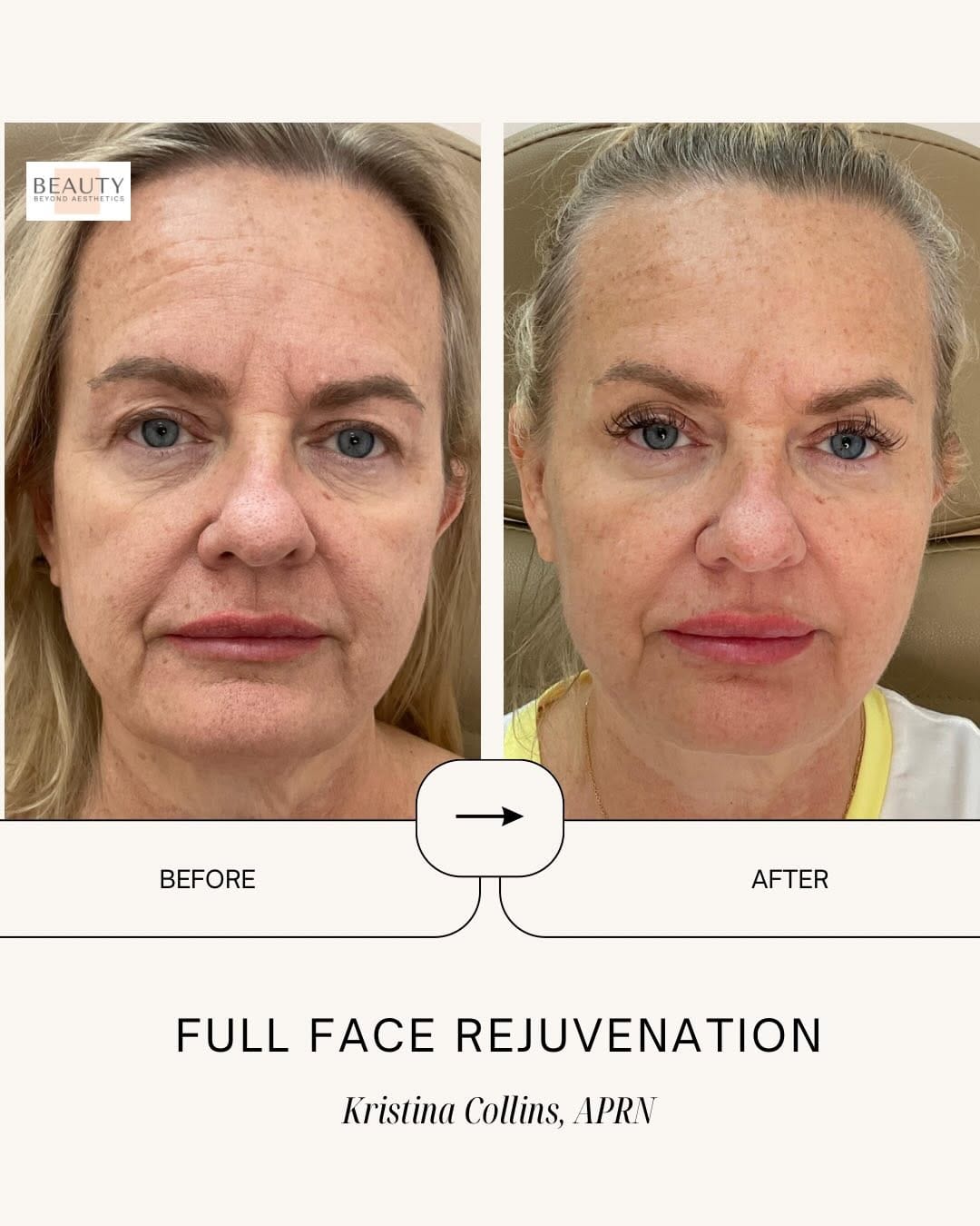 Post 2 by Kristina / Beauty Aesthetics Lakeland MedSpa on Instagram (carousel)