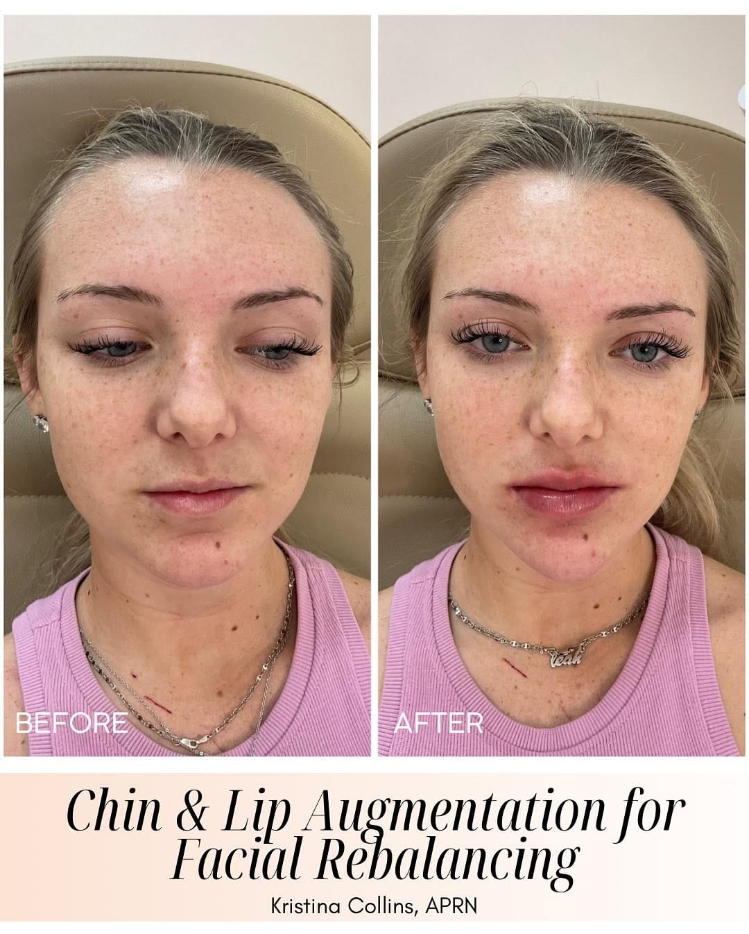 Post 10 by Kristina / Beauty Aesthetics Lakeland MedSpa on Instagram (carousel)