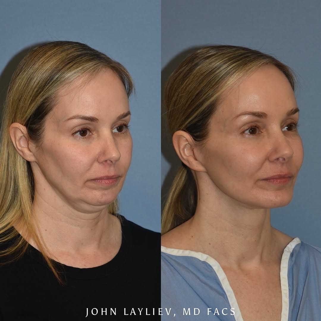Post 10 by John Layliev, MD, FACS on Instagram (carousel)