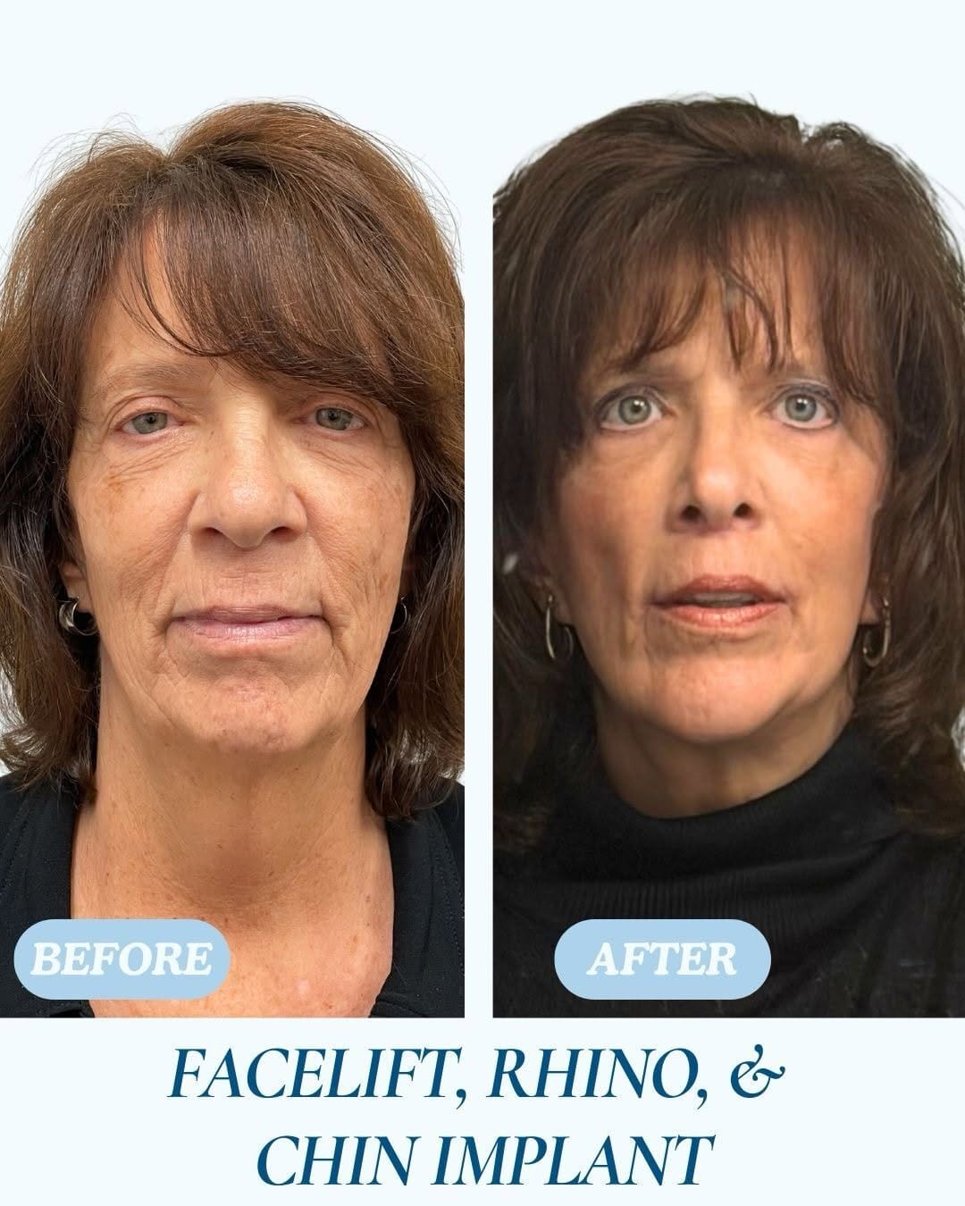 Post 2 by Cosmetic and Plastic Surgery | South Florida on Instagram (carousel)
