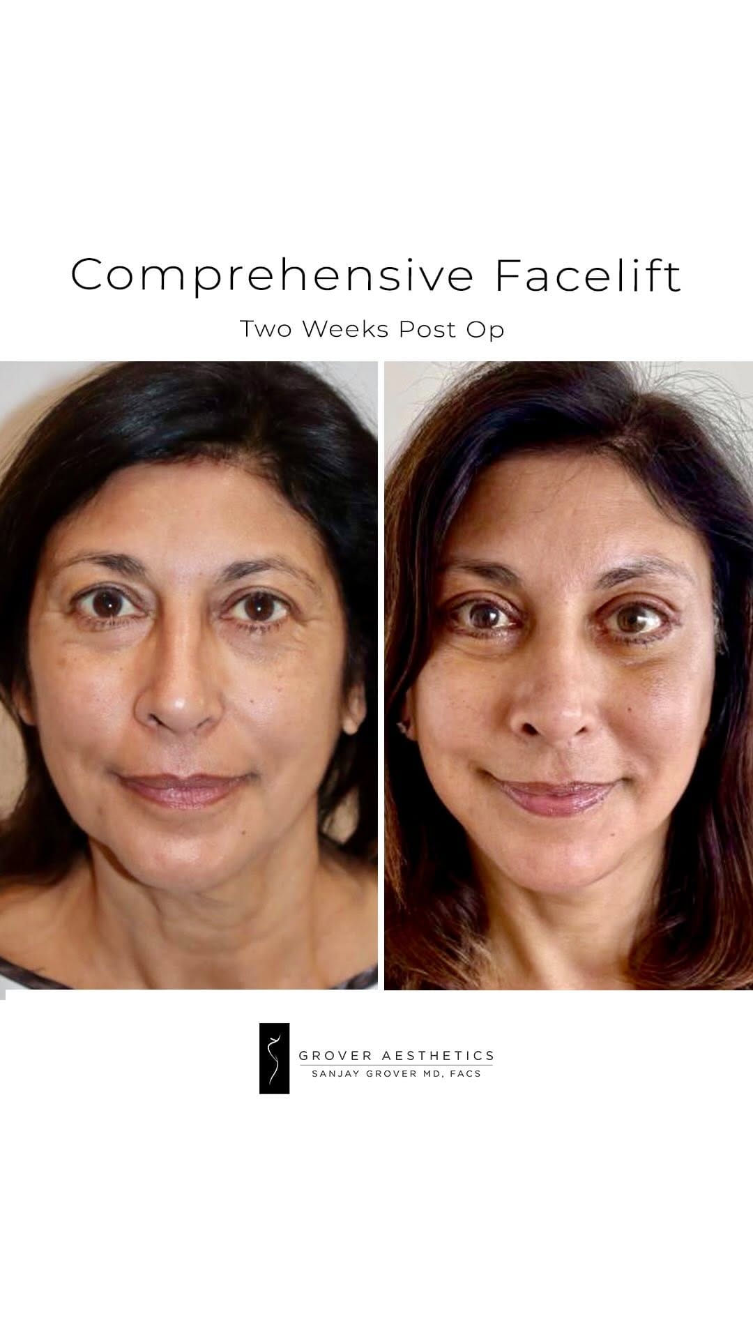 Post 1 by Sanjay Grover MD, FACS on Instagram (video)