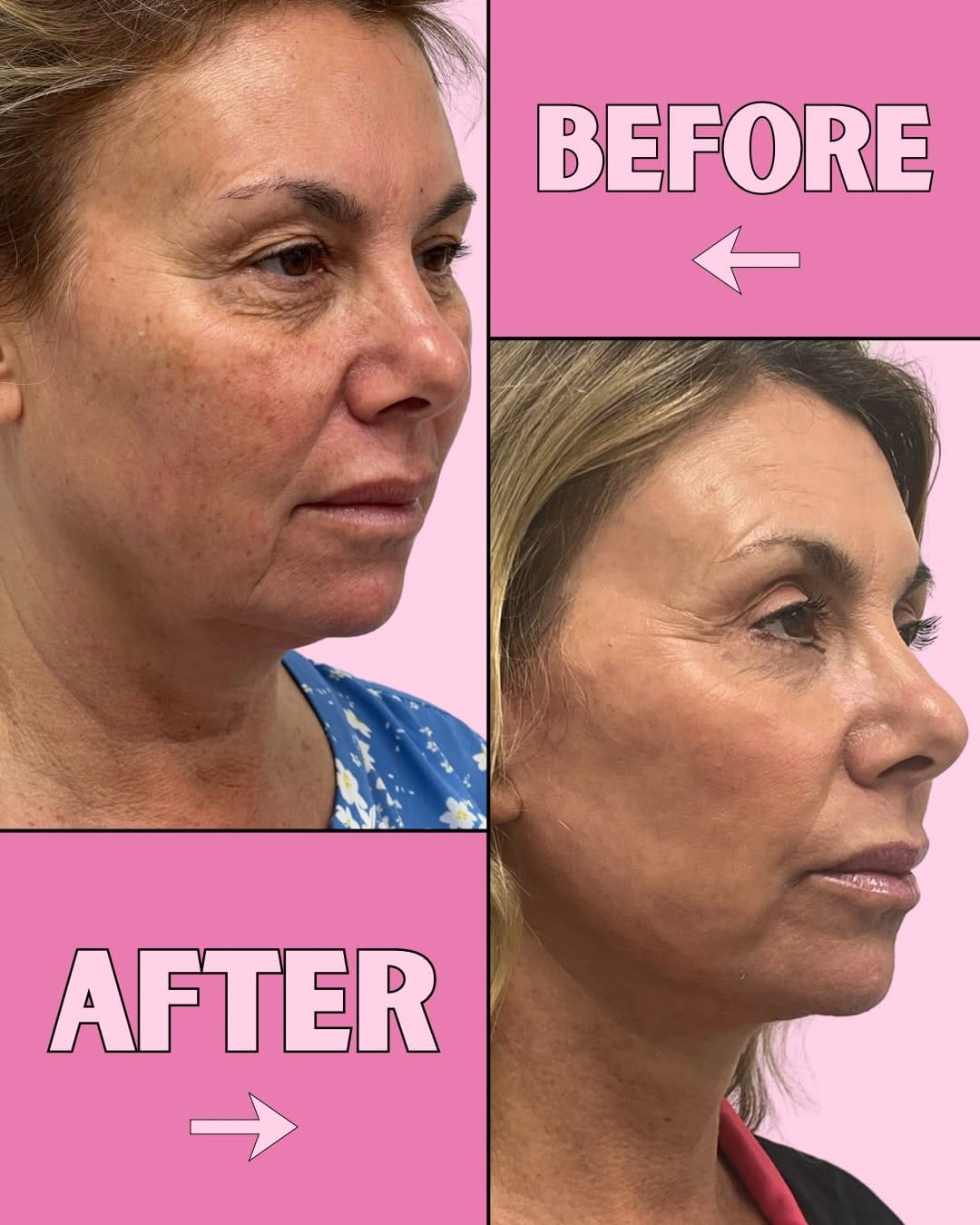 Post 6 by Le Spa Plastic Surgery | Doctor Michael Frederick on Instagram (carousel)