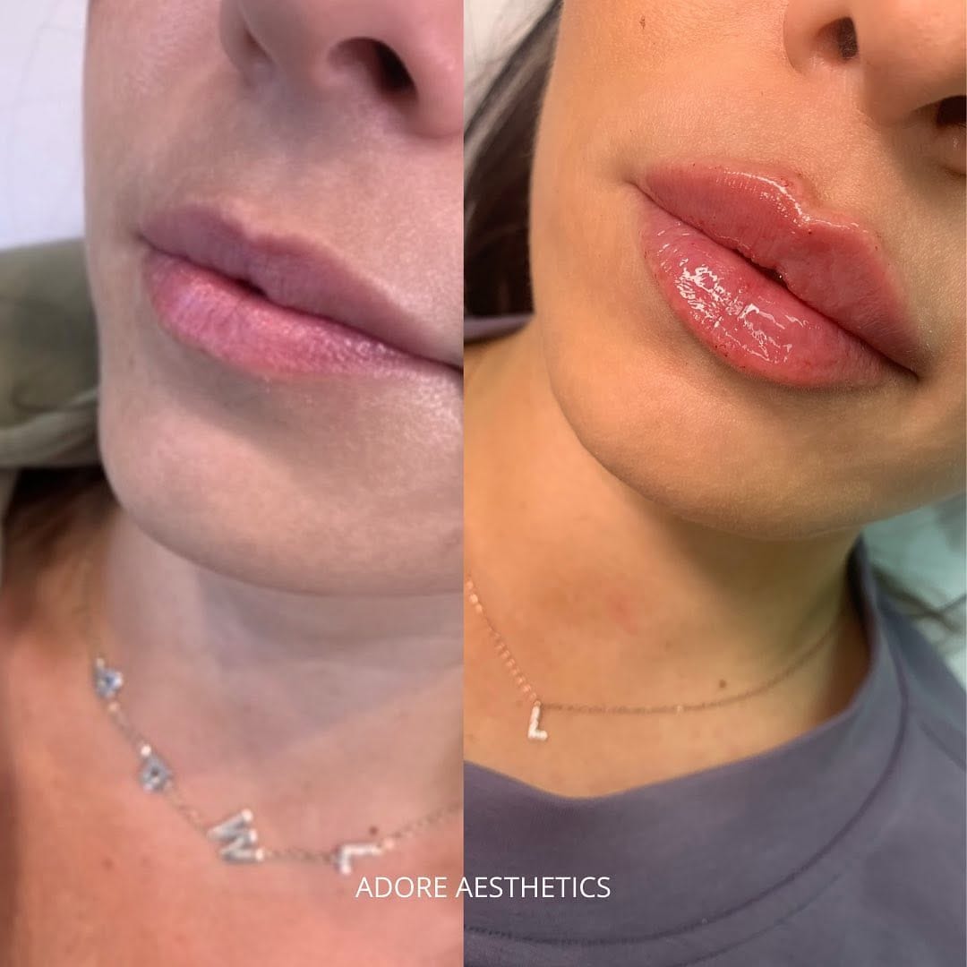 Post 10 by Niagara 🇨🇦 ADORE AESTHETICS 💉 Botox & Filler & Aesthetics ♡ on Instagram (image)