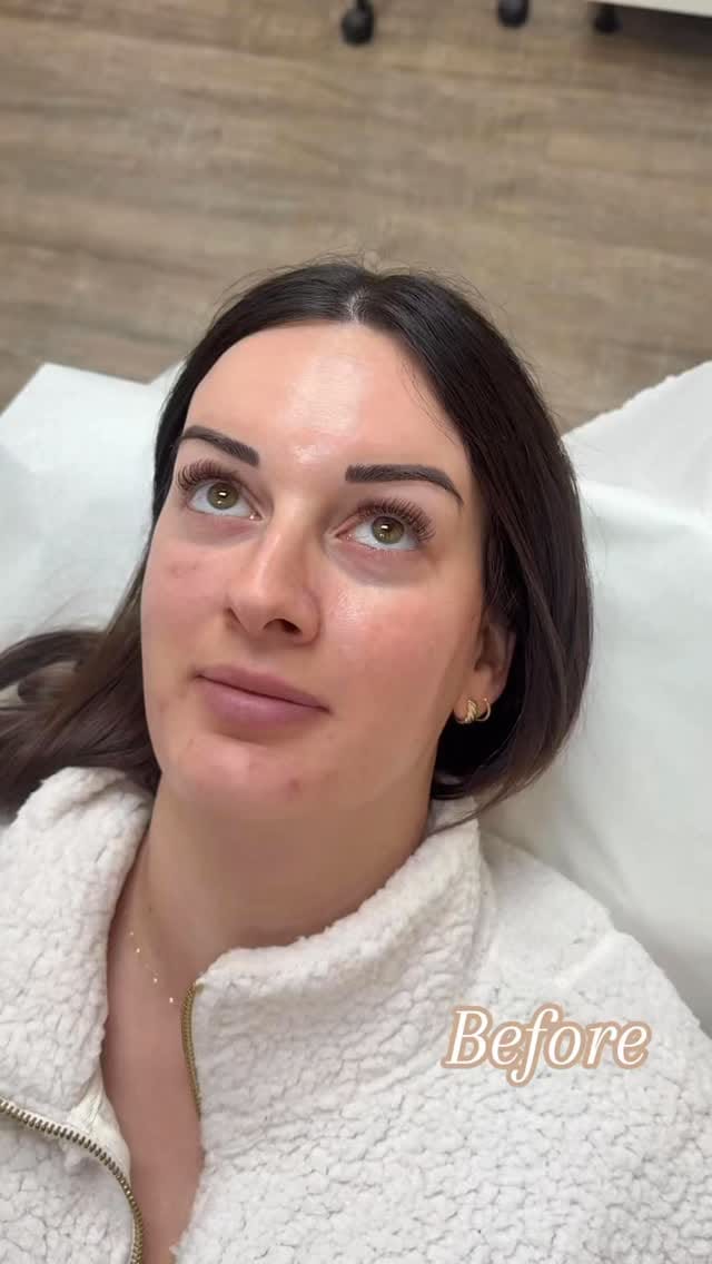 Post 6 by Niagara 🇨🇦 ADORE AESTHETICS 💉 Botox & Filler & Aesthetics ♡ on Instagram (video)