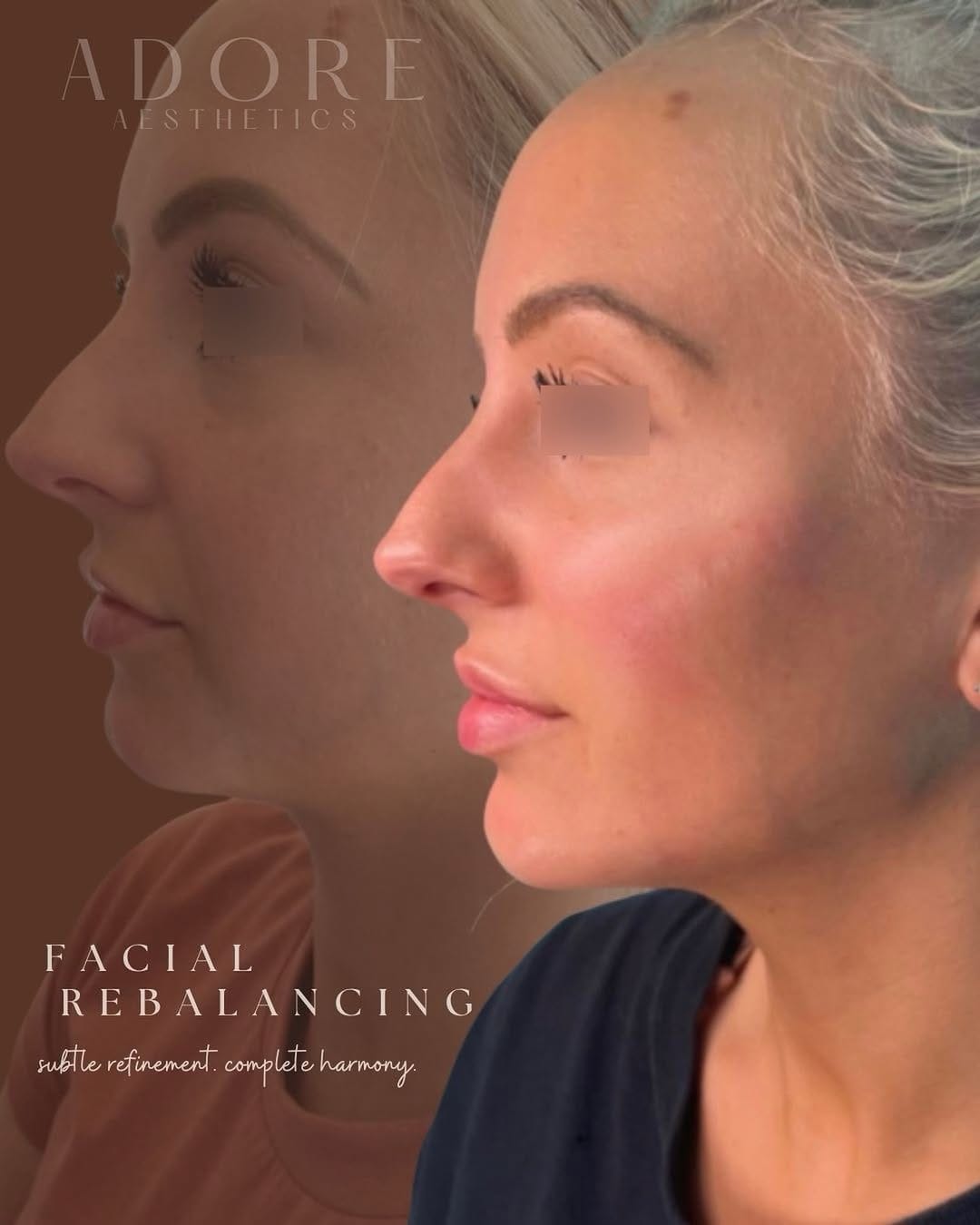 Post 8 by Niagara 🇨🇦 ADORE AESTHETICS 💉 Botox & Filler & Aesthetics ♡ on Instagram (image)