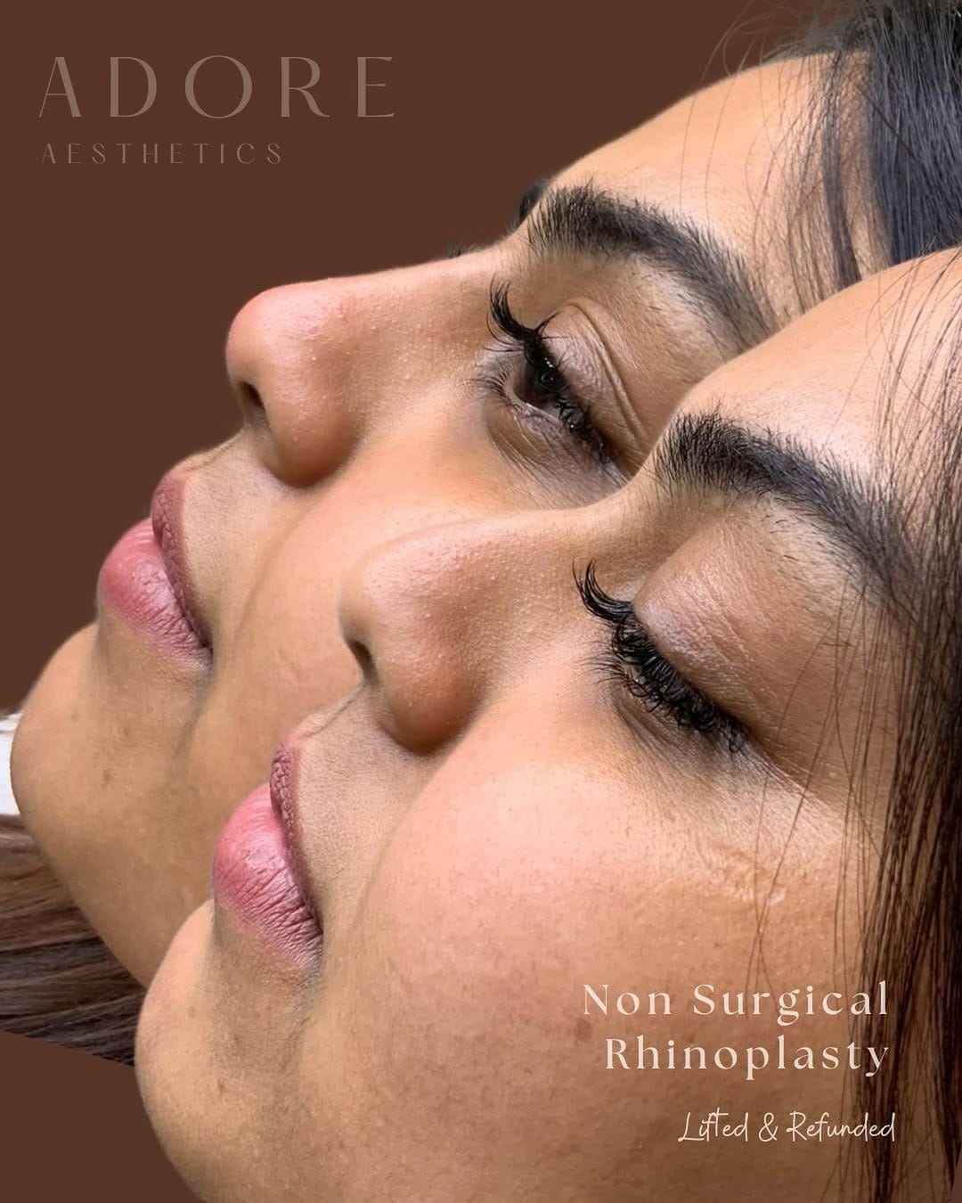 Post 3 by Niagara 🇨🇦 ADORE AESTHETICS 💉 Botox & Filler & Aesthetics ♡ on Instagram (image)