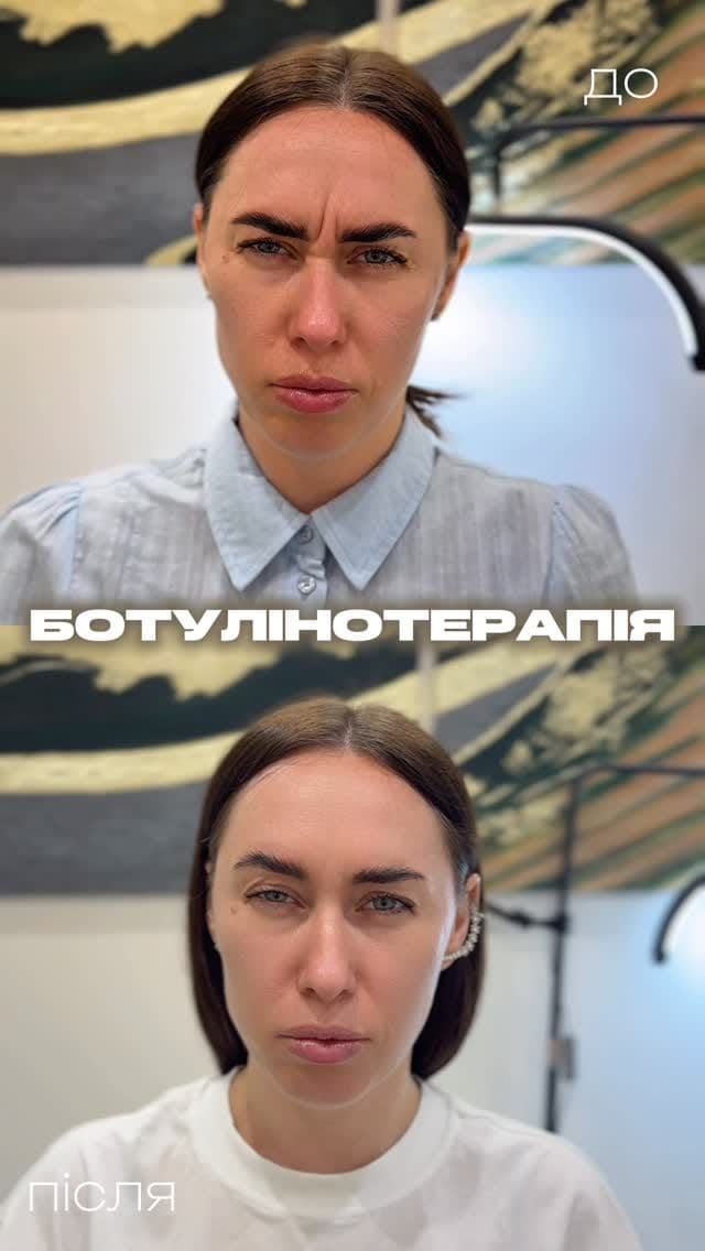 Post 4 by КЛІНІКА | КОСМЕТОЛОГІЯ ДНІПРО 🇺🇦 on Instagram (video)