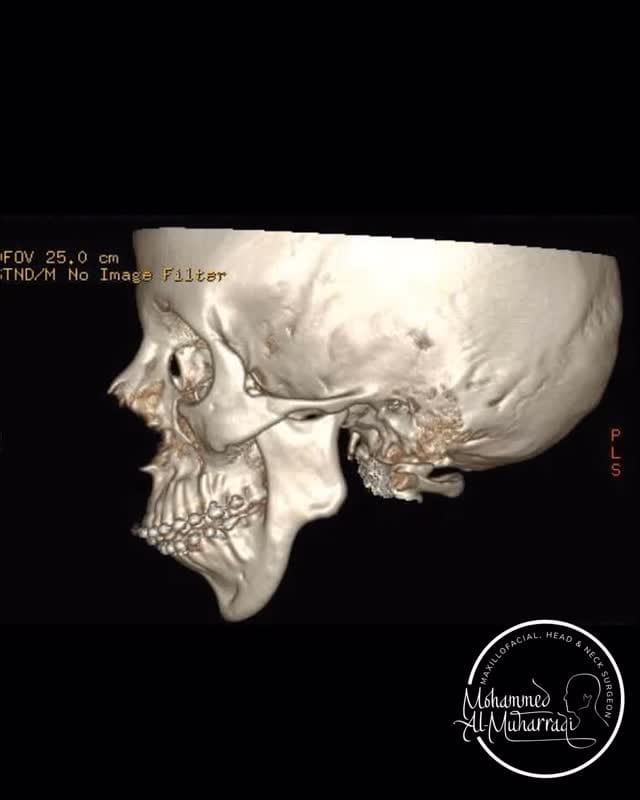 Post 7 by Mohammed A. Al-Muharraqi, FRCS, FDSRCS on Instagram (video)