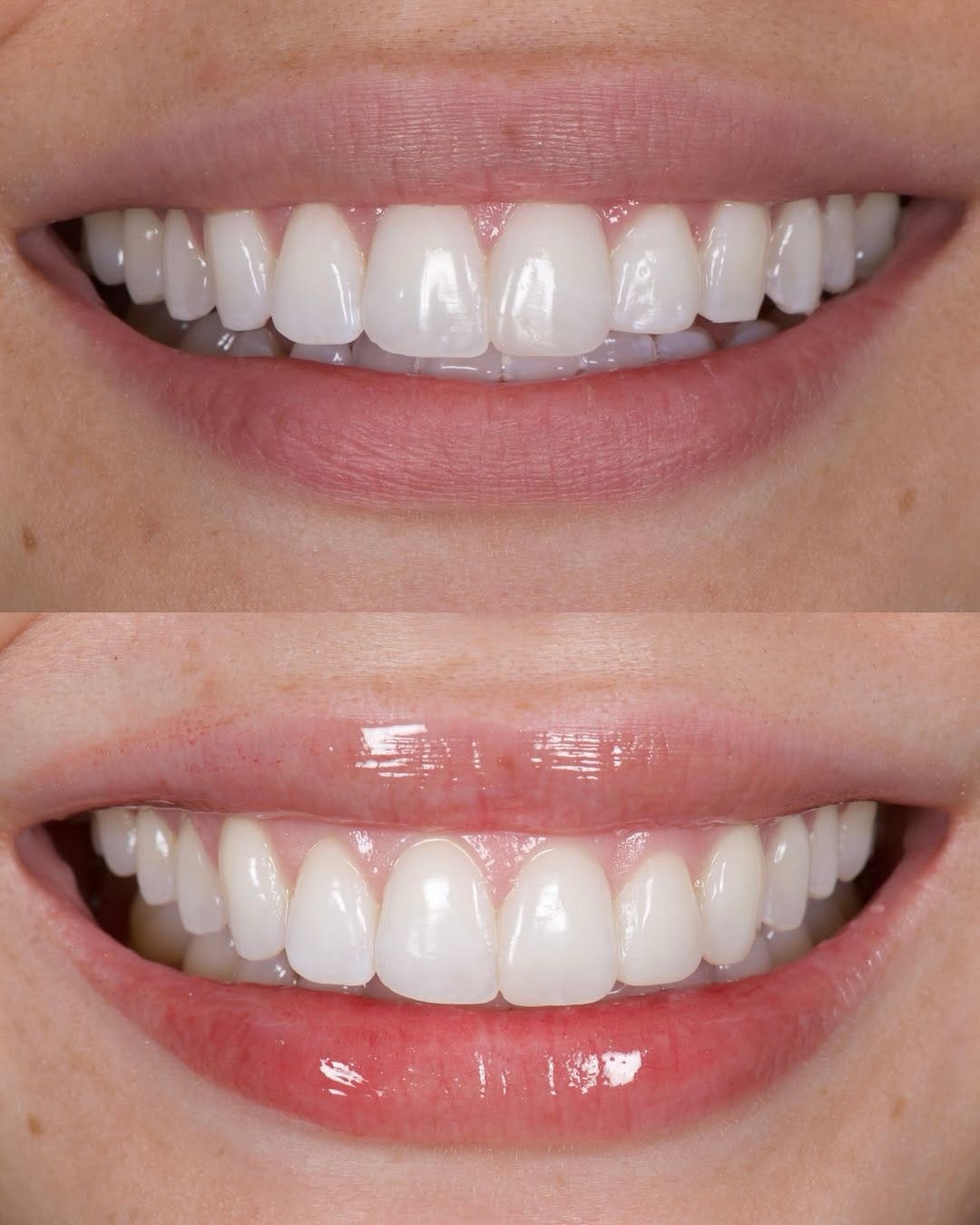 Post 10 by Dr. David Wagner | Veneer Expert on Instagram (image)