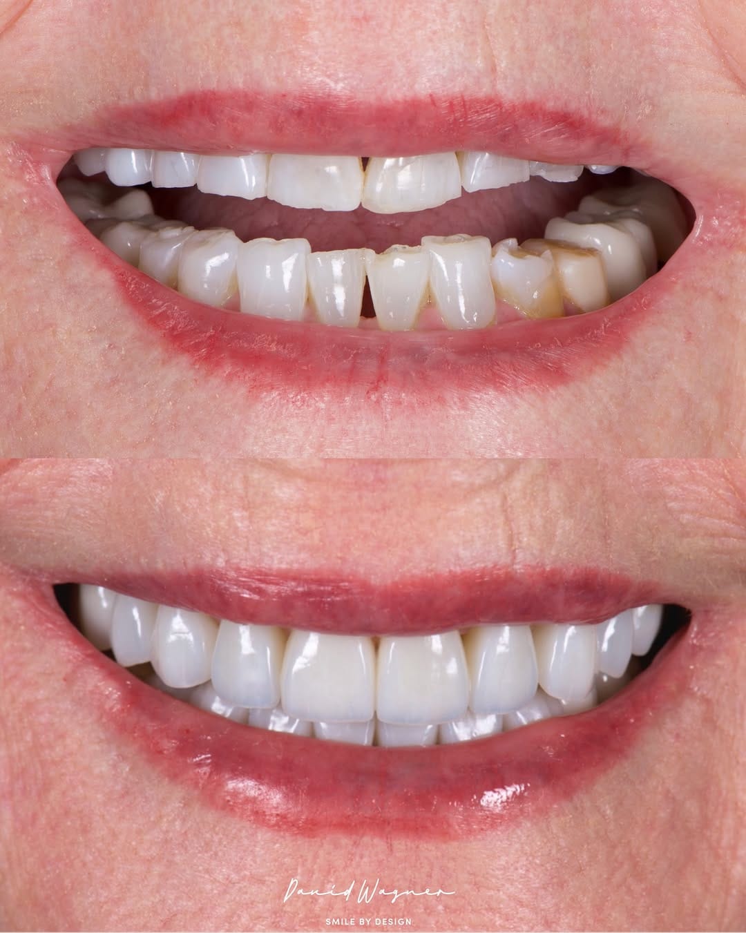 Post 5 by Dr. David Wagner | Veneer Expert on Instagram (carousel)