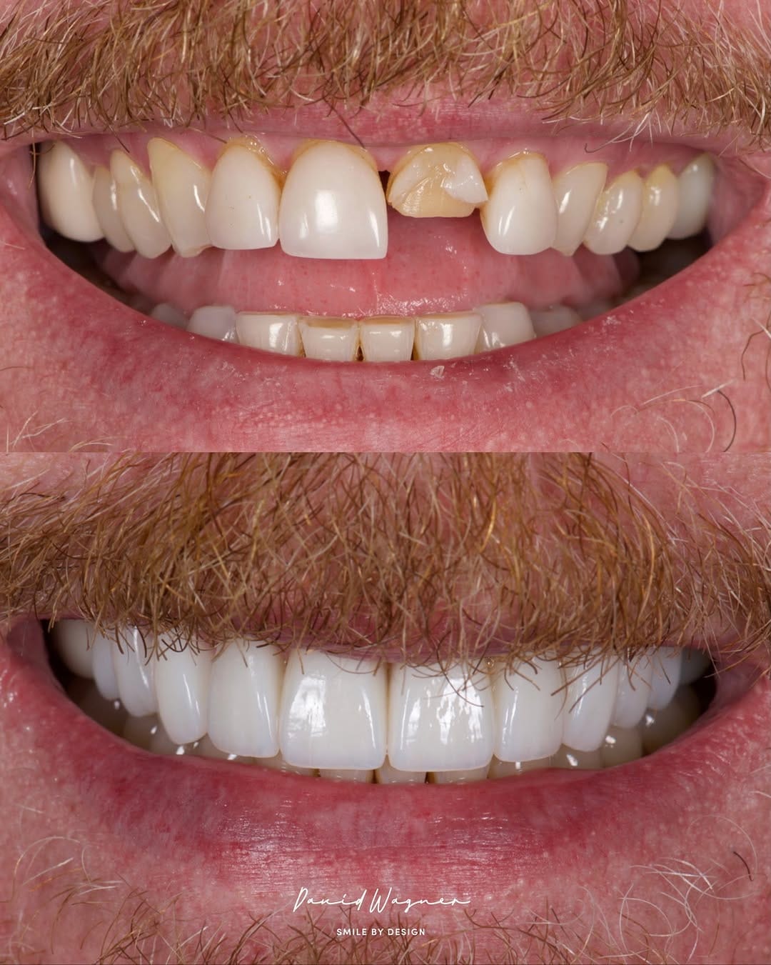 Post 3 by Dr. David Wagner | Veneer Expert on Instagram (image)