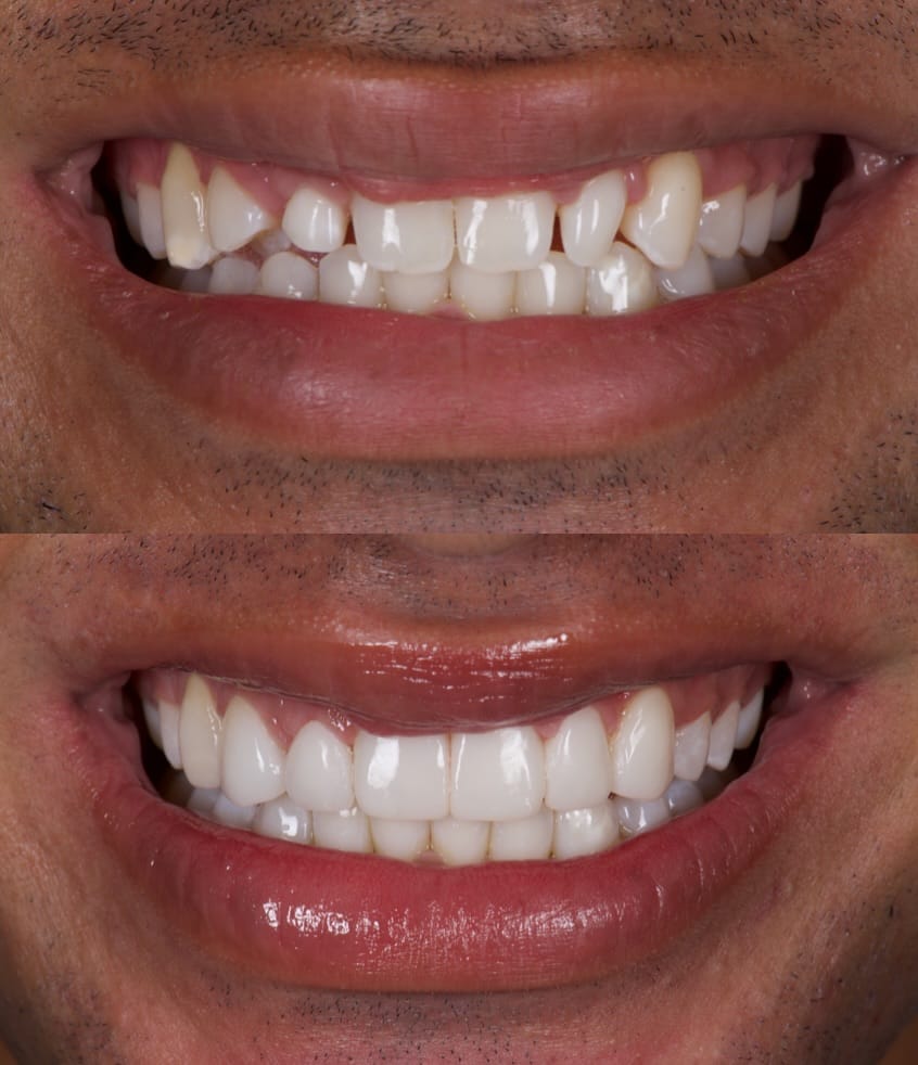 Post 7 by Dr. David Wagner | Veneer Expert on Instagram (carousel)