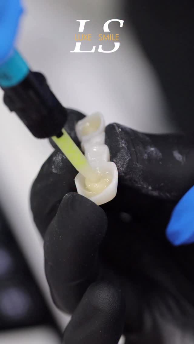 Post 4 by Luxe Smile | Porcelain Veneers on Instagram (video)