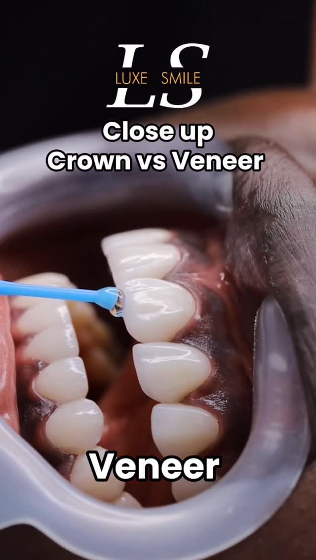 Post 5 by Luxe Smile | Porcelain Veneers on Instagram (video)