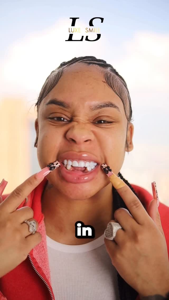 Post 9 by Luxe Smile | Porcelain Veneers on Instagram (video)