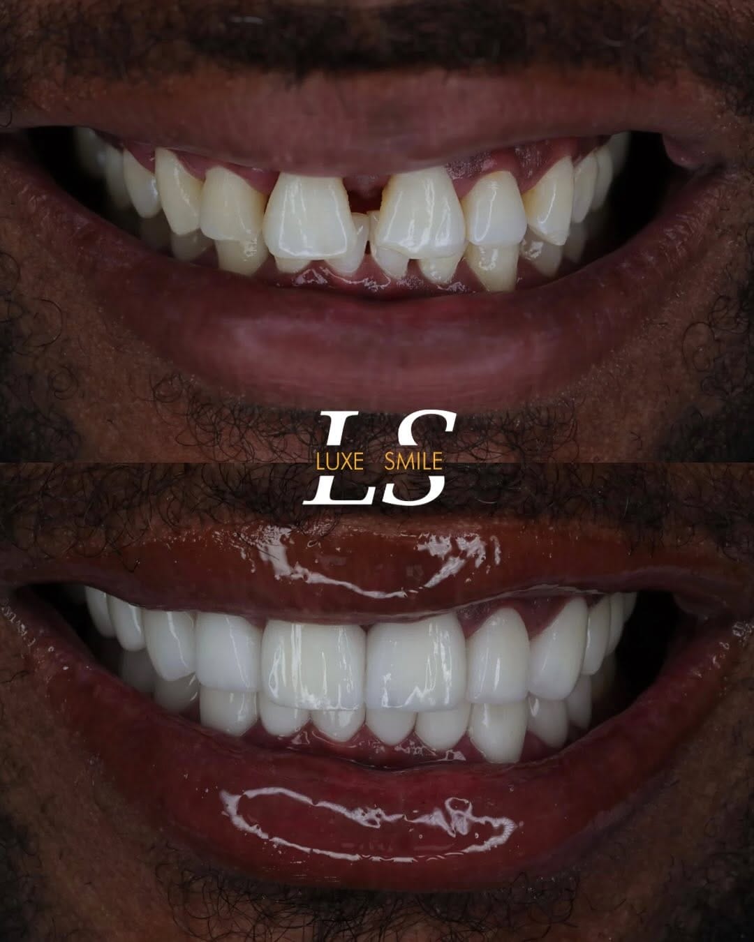 Post 2 by Luxe Smile | Porcelain Veneers on Instagram (carousel)
