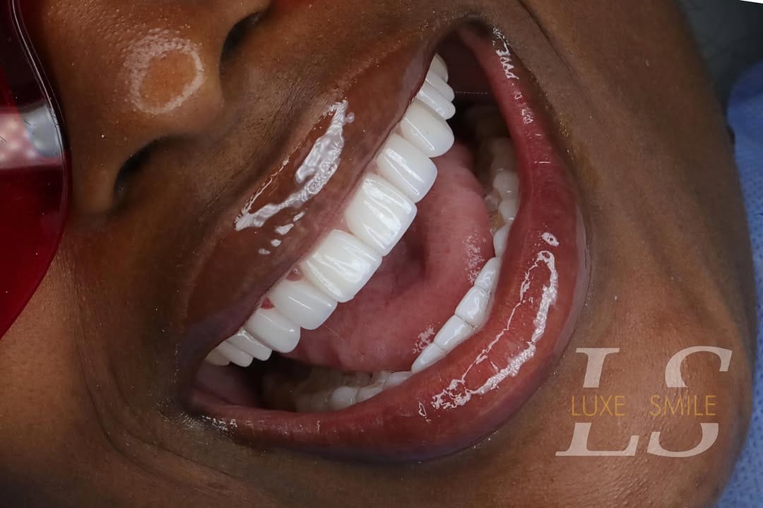 Post 7 by Luxe Smile | Porcelain Veneers on Instagram (image)