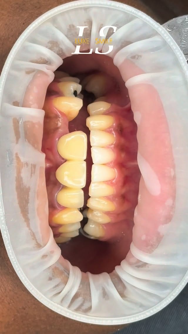 Post 1 by Luxe Smile | Porcelain Veneers on Instagram (video)