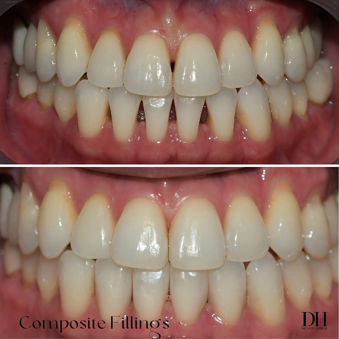 Post 10 by Dr. Hailat | Houston Dentist on Instagram (carousel)