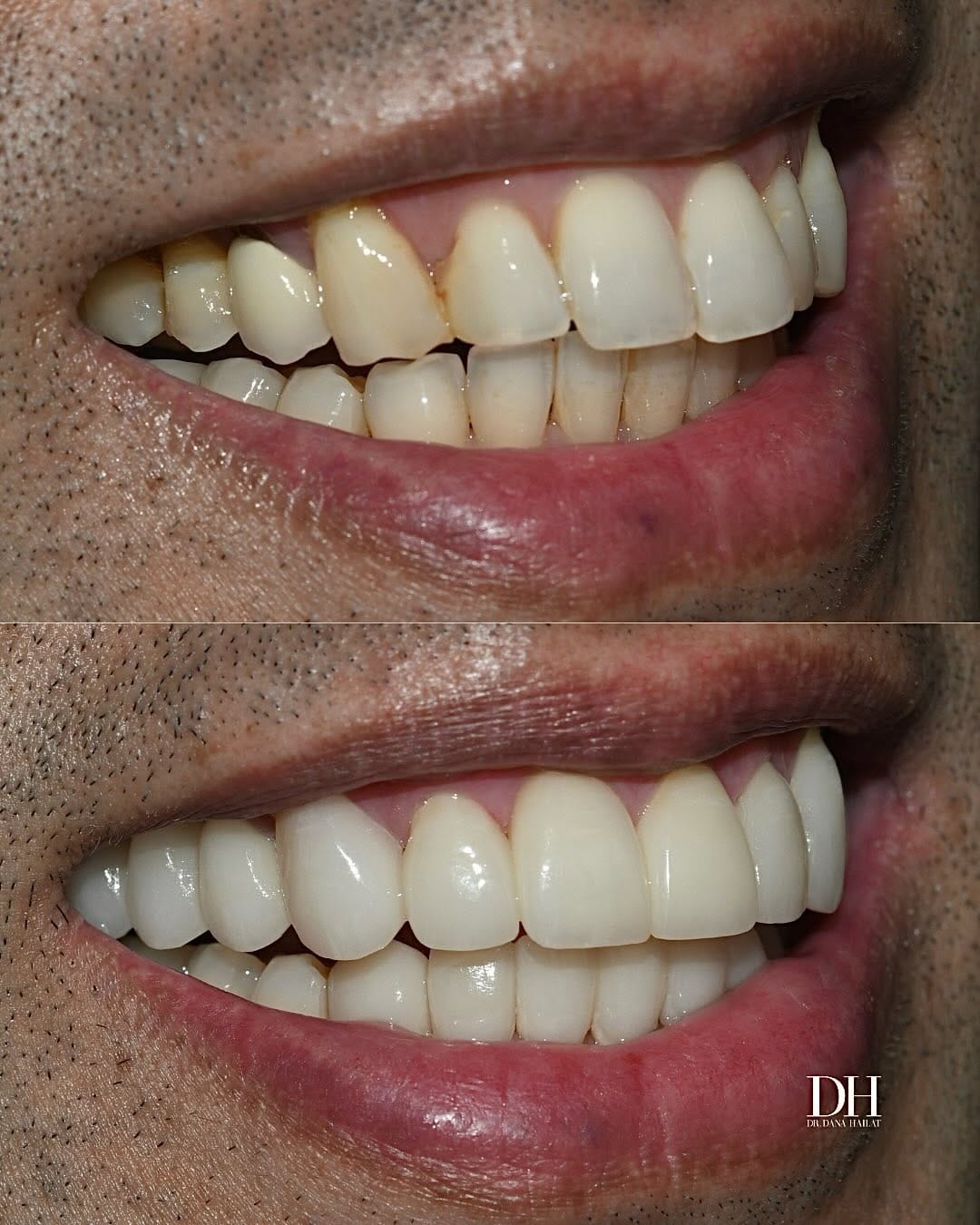Post 7 by Dr. Hailat | Houston Dentist on Instagram (carousel)
