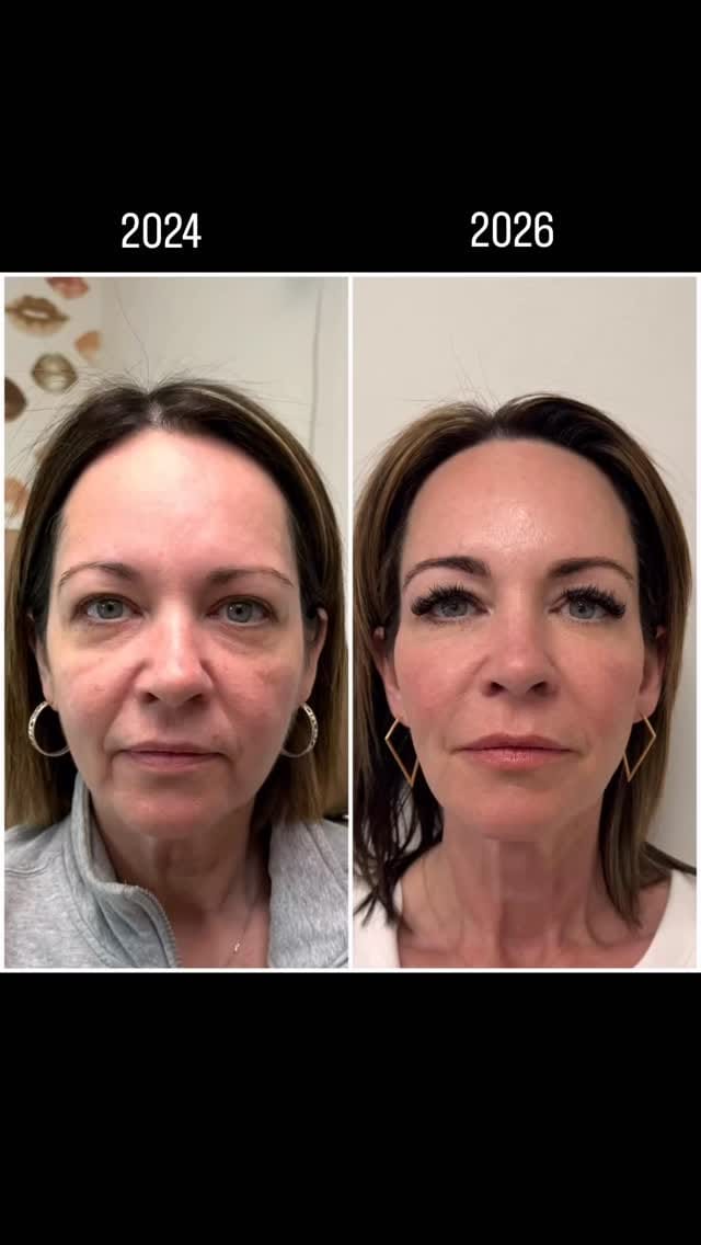 Post 8 by Katrina Flowers  PA-C, MCHS 🩺|’Tox|Filler|Skincare|Lasers| on Instagram (video)