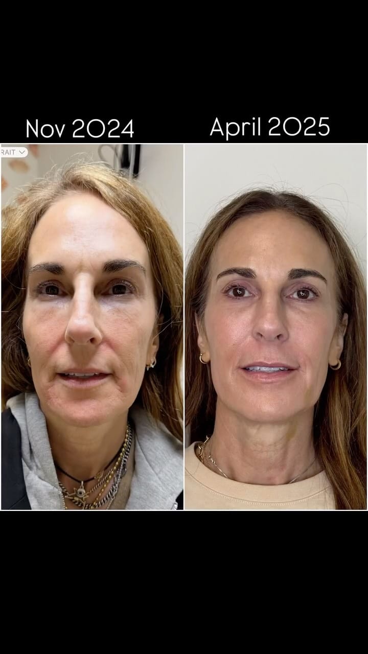 Post 10 by Katrina Flowers  PA-C, MCHS 🩺|’Tox|Filler|Skincare|Lasers| on Instagram (video)