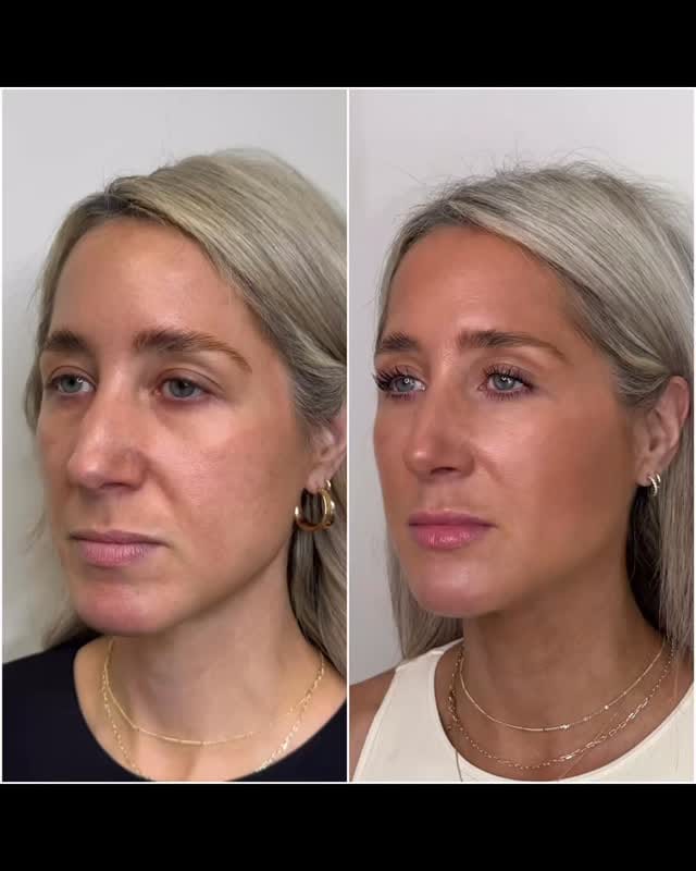 Post 9 by Katrina Flowers  PA-C, MCHS 🩺|’Tox|Filler|Skincare|Lasers| on Instagram (video)