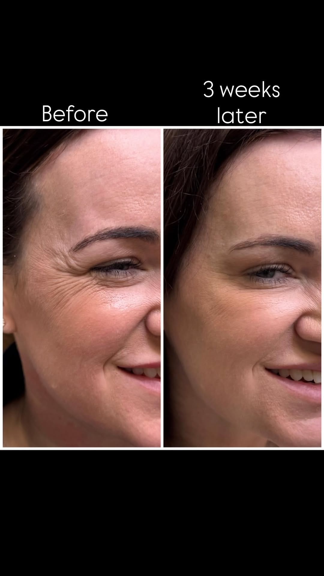 Post 1 by Katrina Flowers  PA-C, MCHS 🩺|’Tox|Filler|Skincare|Lasers| on Instagram (video)
