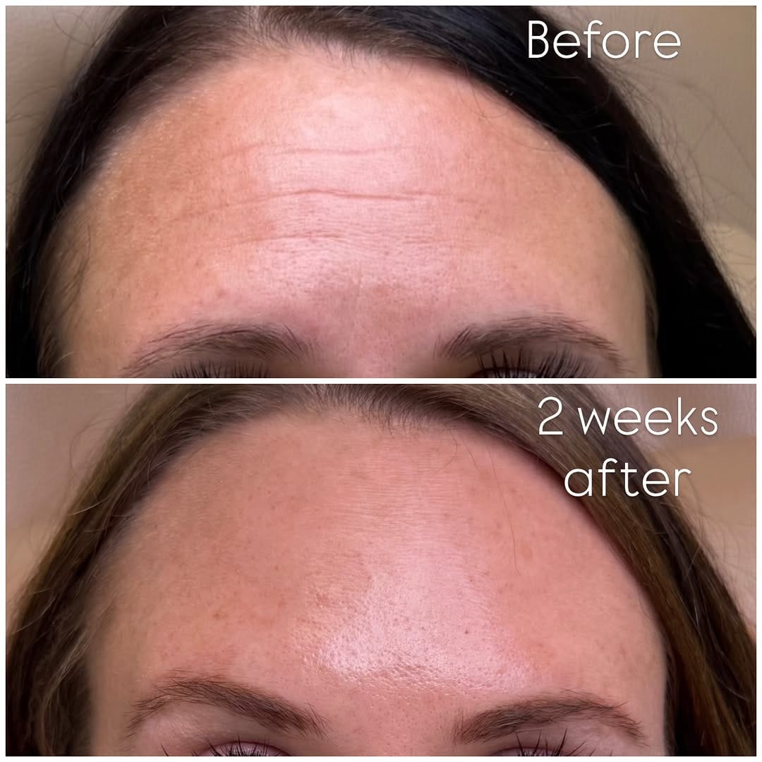 Post 5 by Katrina Flowers  PA-C, MCHS 🩺|’Tox|Filler|Skincare|Lasers| on Instagram (image)