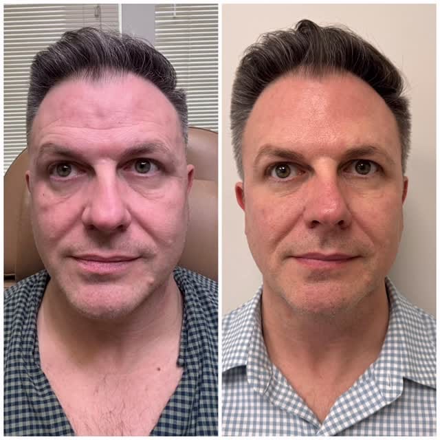 Post 2 by Katrina Flowers  PA-C, MCHS 🩺|’Tox|Filler|Skincare|Lasers| on Instagram (video)
