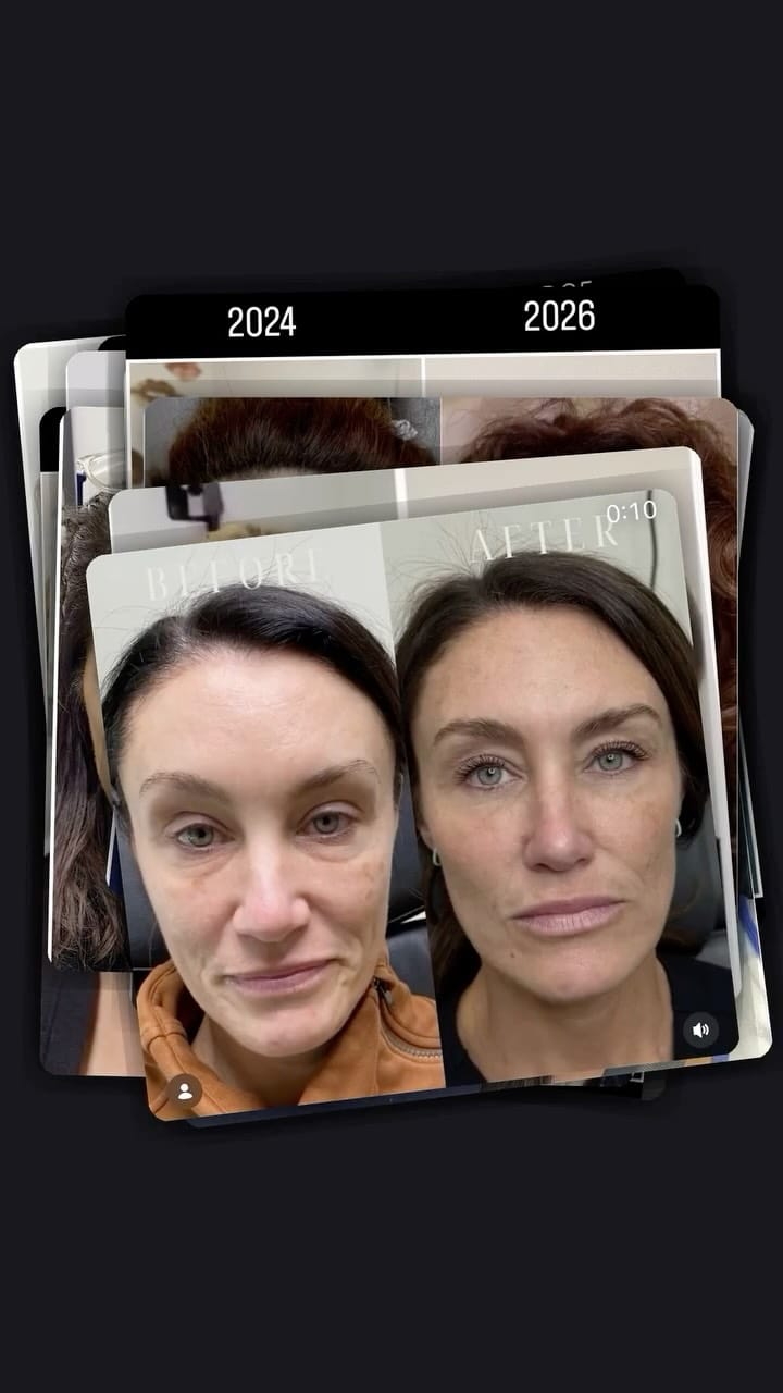 Post 4 by Katrina Flowers  PA-C, MCHS 🩺|’Tox|Filler|Skincare|Lasers| on Instagram (video)