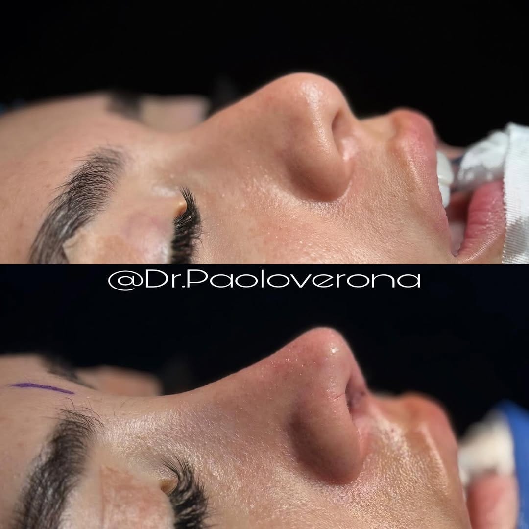Post 9 by Dr. Paolo Verona OMFS on Instagram (carousel)