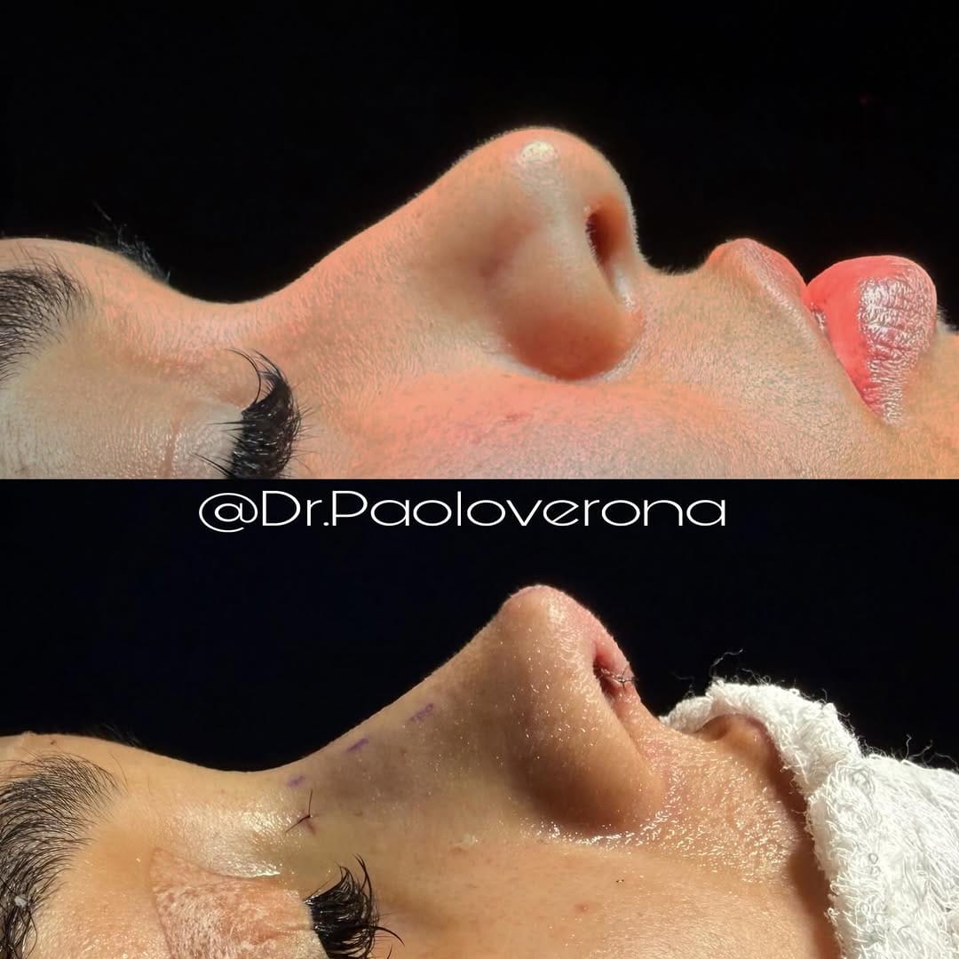 Post 10 by Dr. Paolo Verona OMFS on Instagram (carousel)