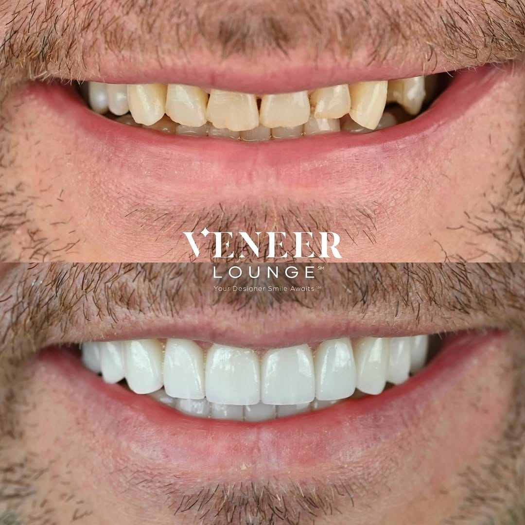 Post 10 by Tania Carvalho, DDS | Cosmetic Dentist in Dallas on Instagram (carousel)