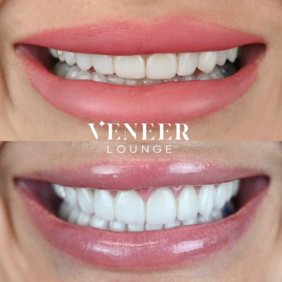 Post 9 by Tania Carvalho, DDS | Cosmetic Dentist in Dallas on Instagram (carousel)