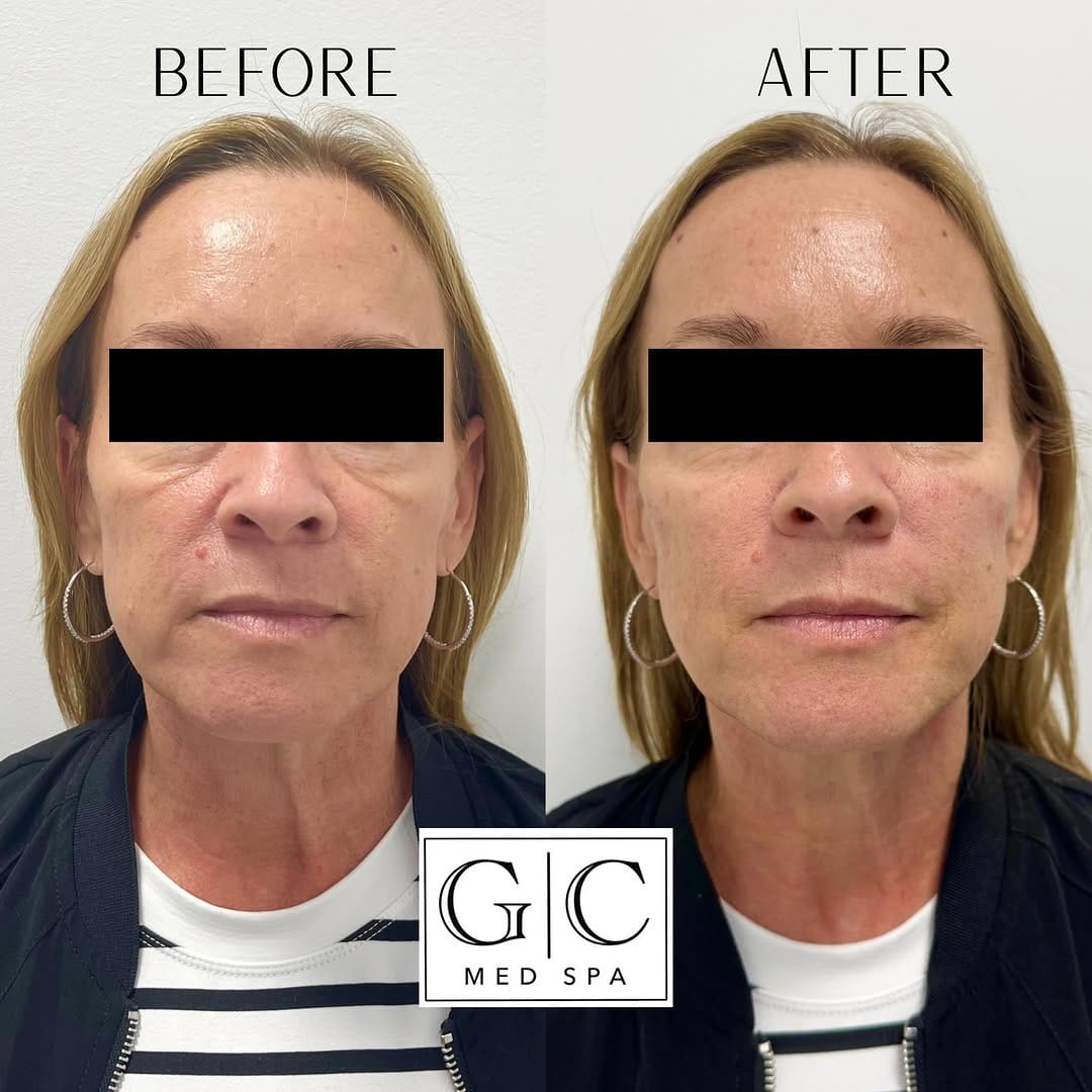 Post 4 by Gulf Coast Medspa on Instagram (carousel)