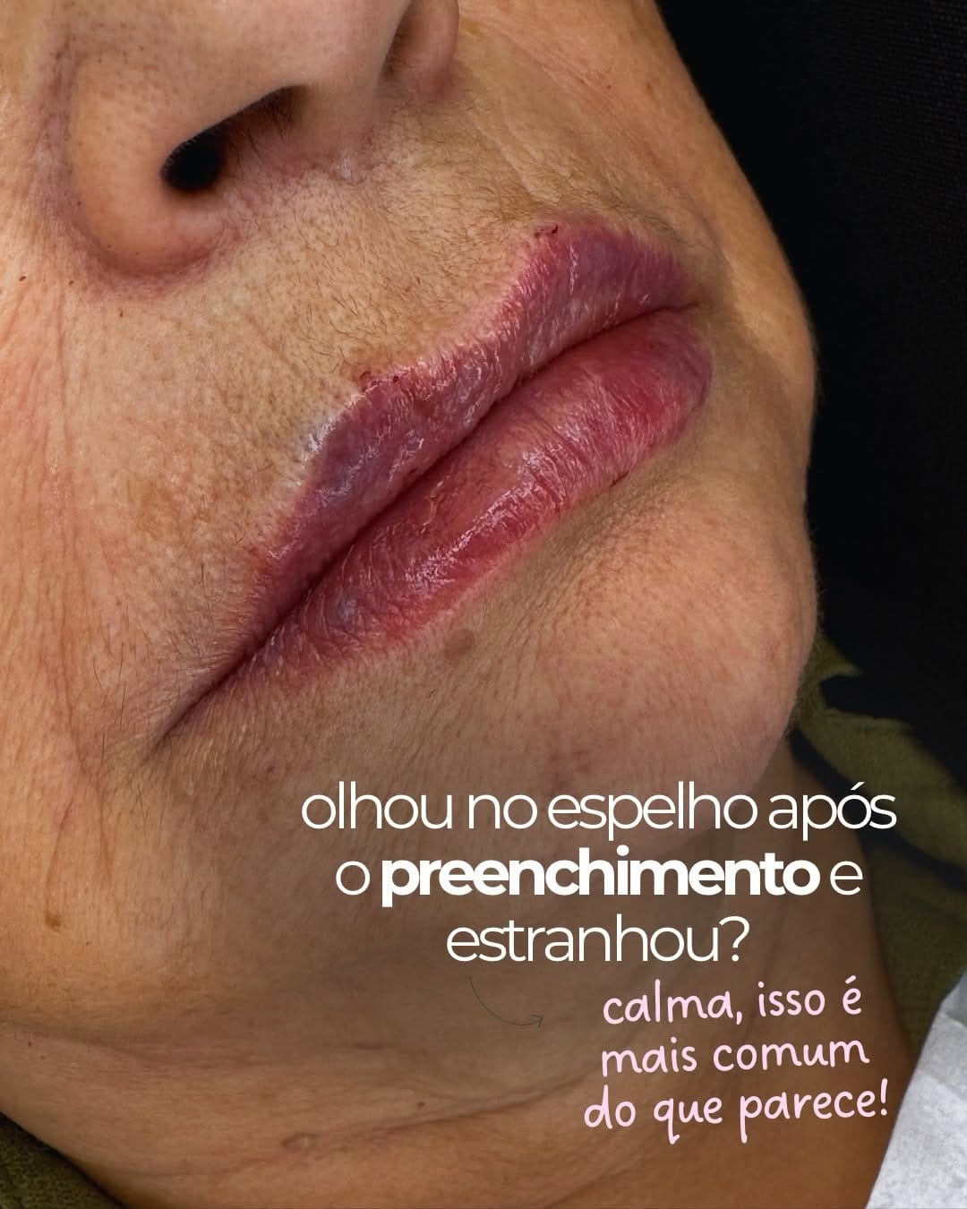 Post 8 by Dra Jana Murai | HARMONIZAÇÃO FACIAL on Instagram (carousel)
