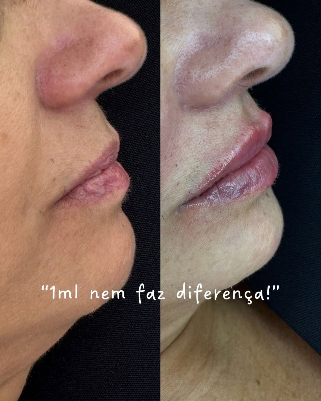 Post 1 by Dra Jana Murai | HARMONIZAÇÃO FACIAL on Instagram (carousel)
