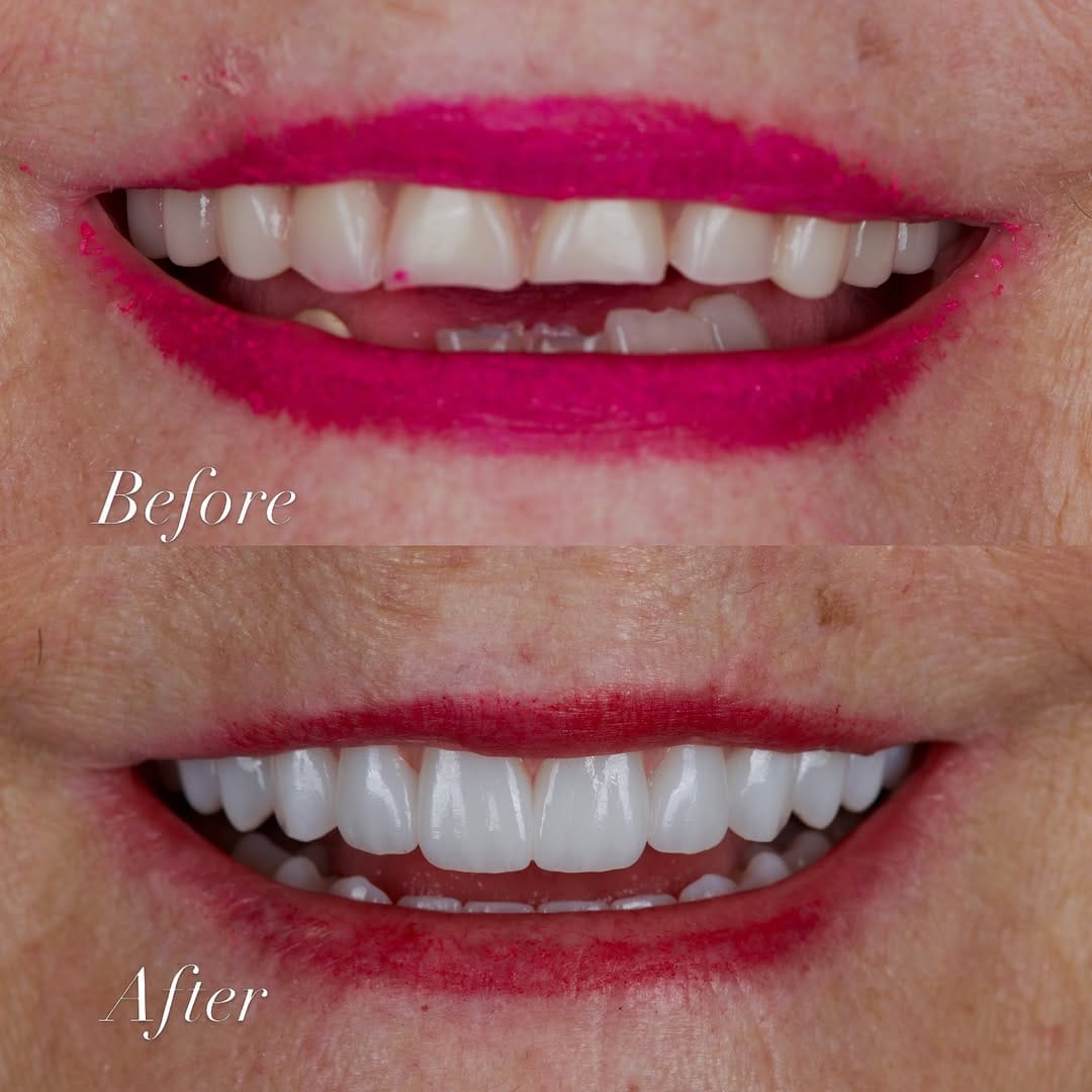 Post 6 by AVIVA Dental Implant Center on Instagram (carousel)