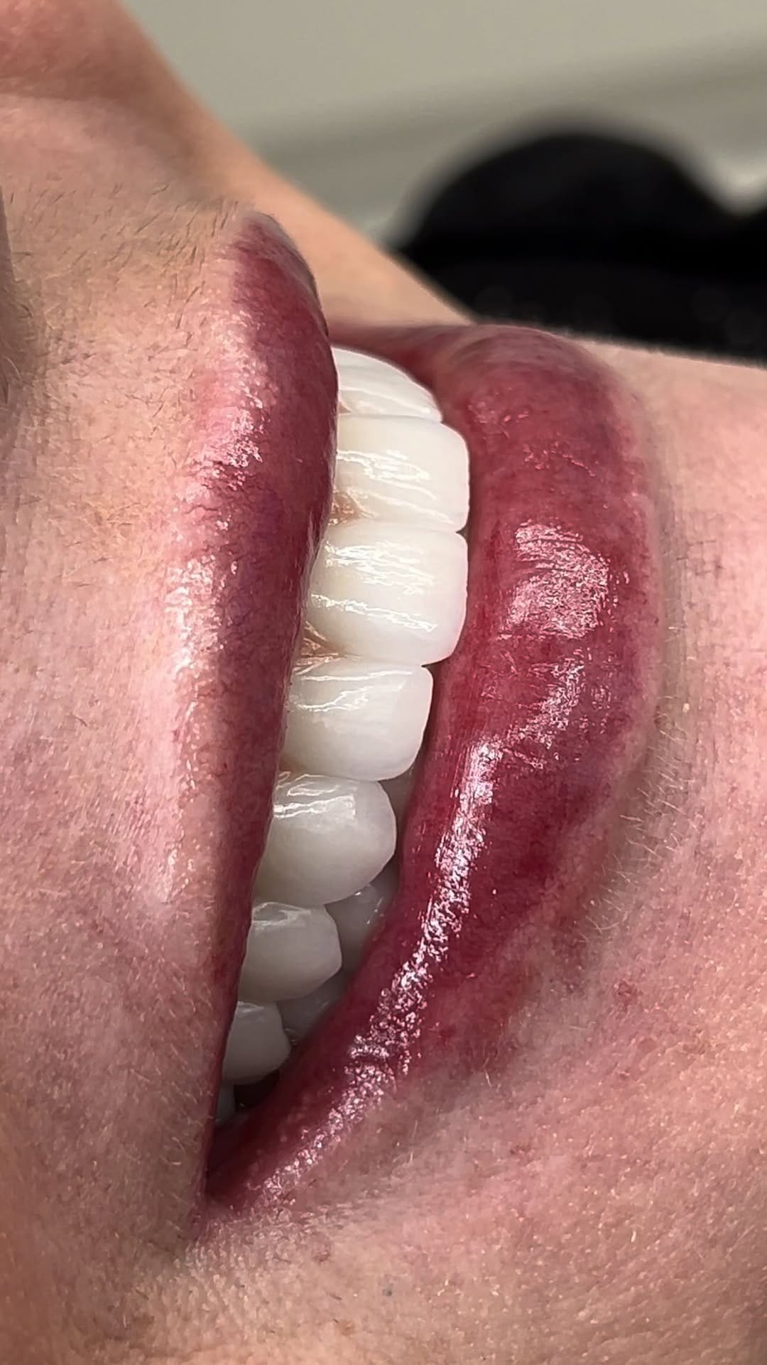 Post 10 by AVIVA Dental Implant Center on Instagram (video)