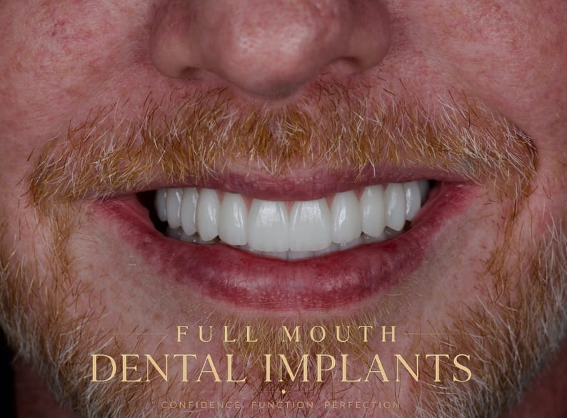 Post 1 by AVIVA Dental Implant Center on Instagram (carousel)