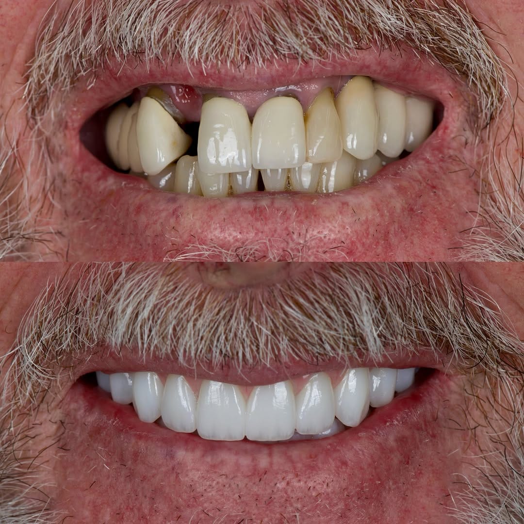 Post 4 by AVIVA Dental Implant Center on Instagram (image)