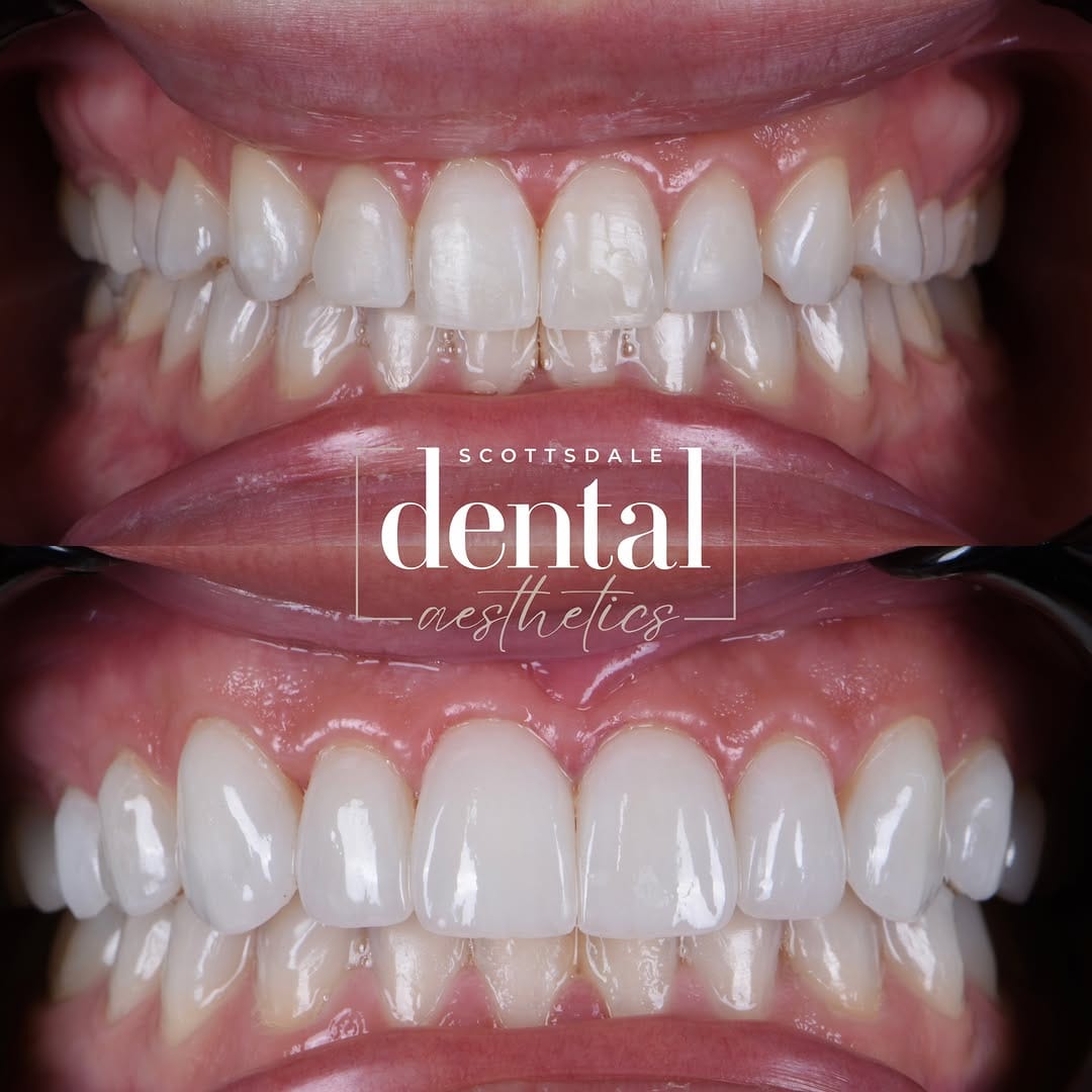 Post 6 by Dr. Omar Karaboulad | Porcelain Veneers in Scottsdale on Instagram (image)