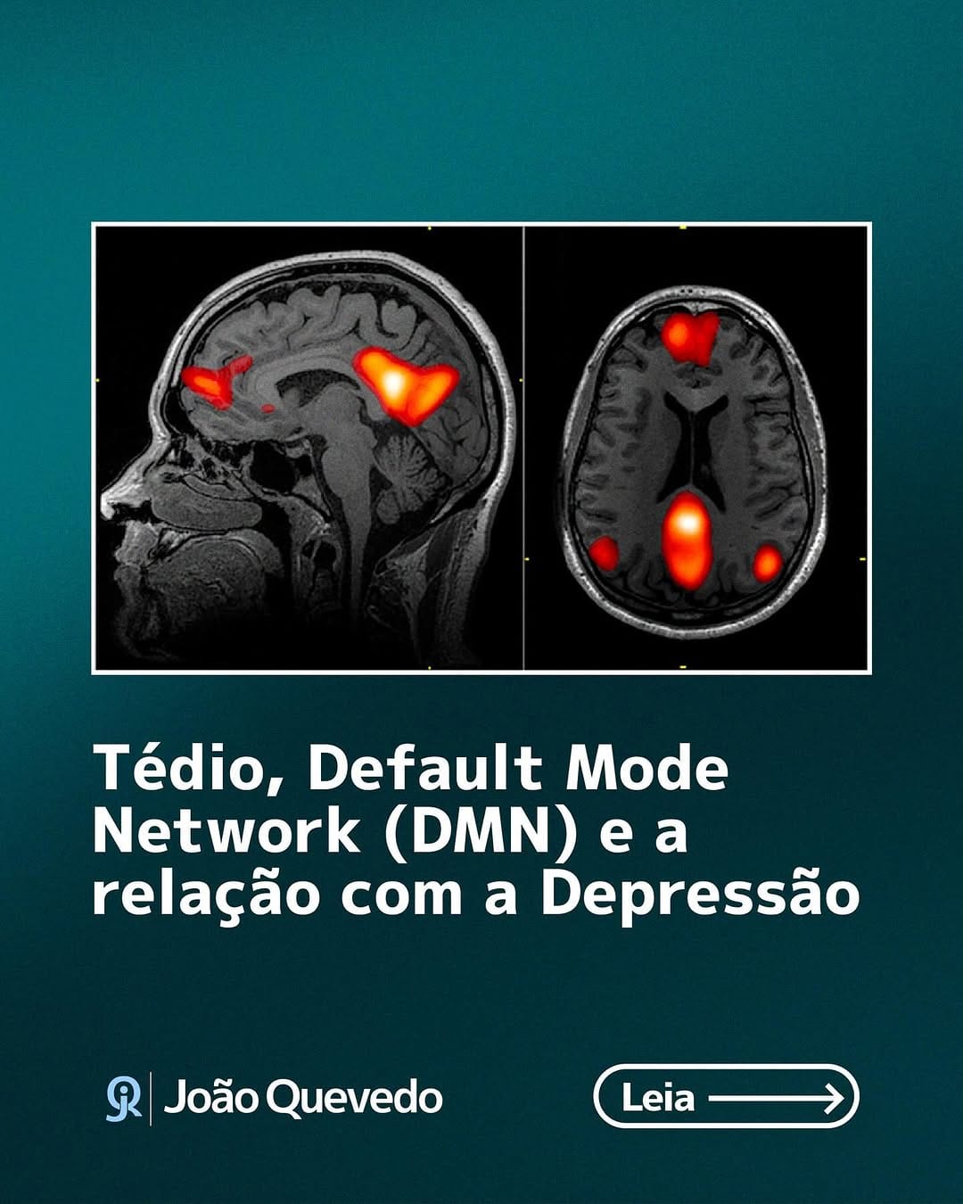 Post 10 by João L. de Quevedo, MD, PhD on Instagram (carousel)