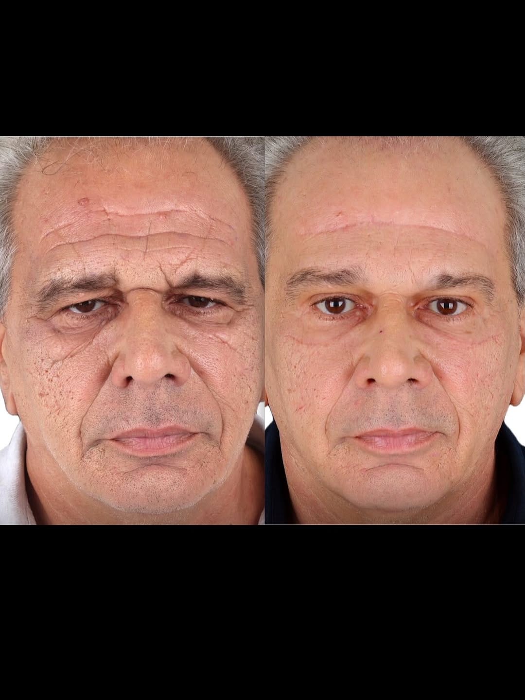 Post 8 by Dr. John Shamoun Aesthetics on Instagram (carousel)