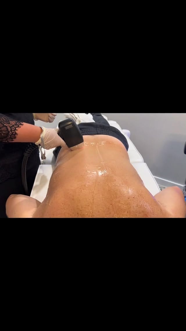 Post 1 by Sonia Cona | Acne Specialist Brampton on Instagram (video)