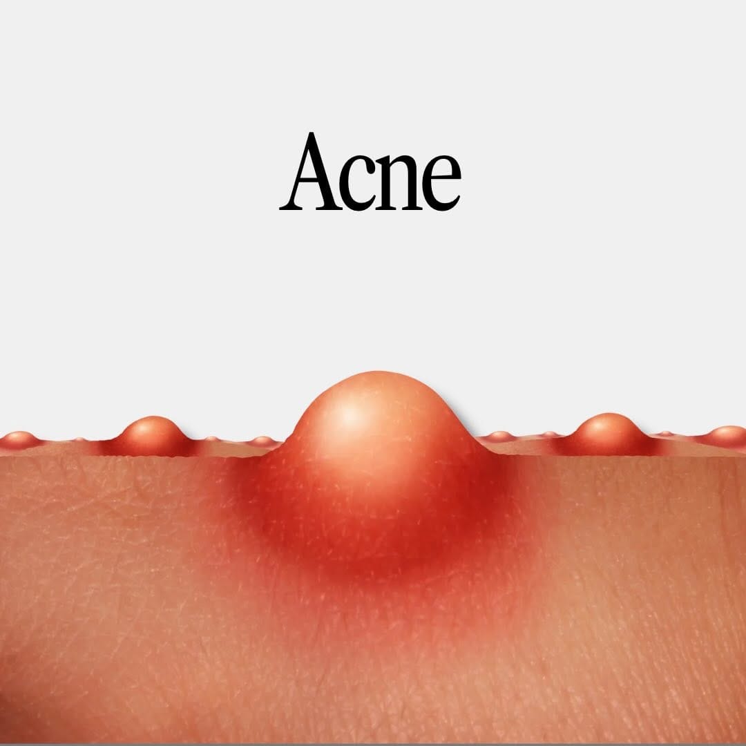 Post 7 by Sonia Cona | Acne Specialist Brampton on Instagram (carousel)