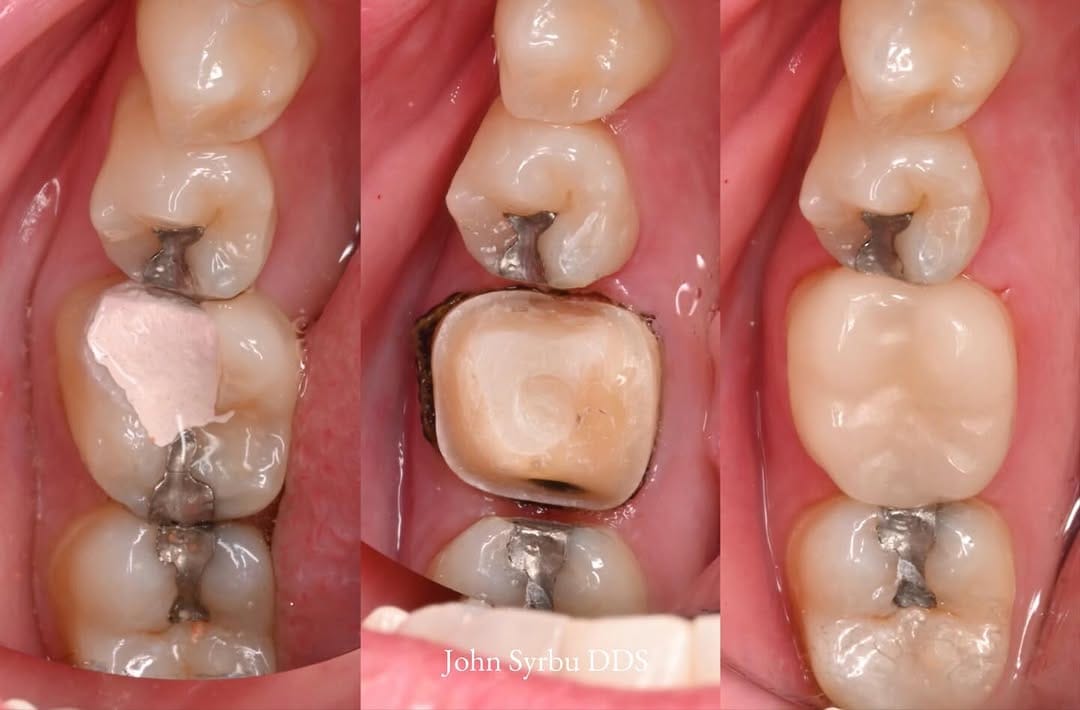 Post 5 by John Syrbu DDS on Instagram (carousel)